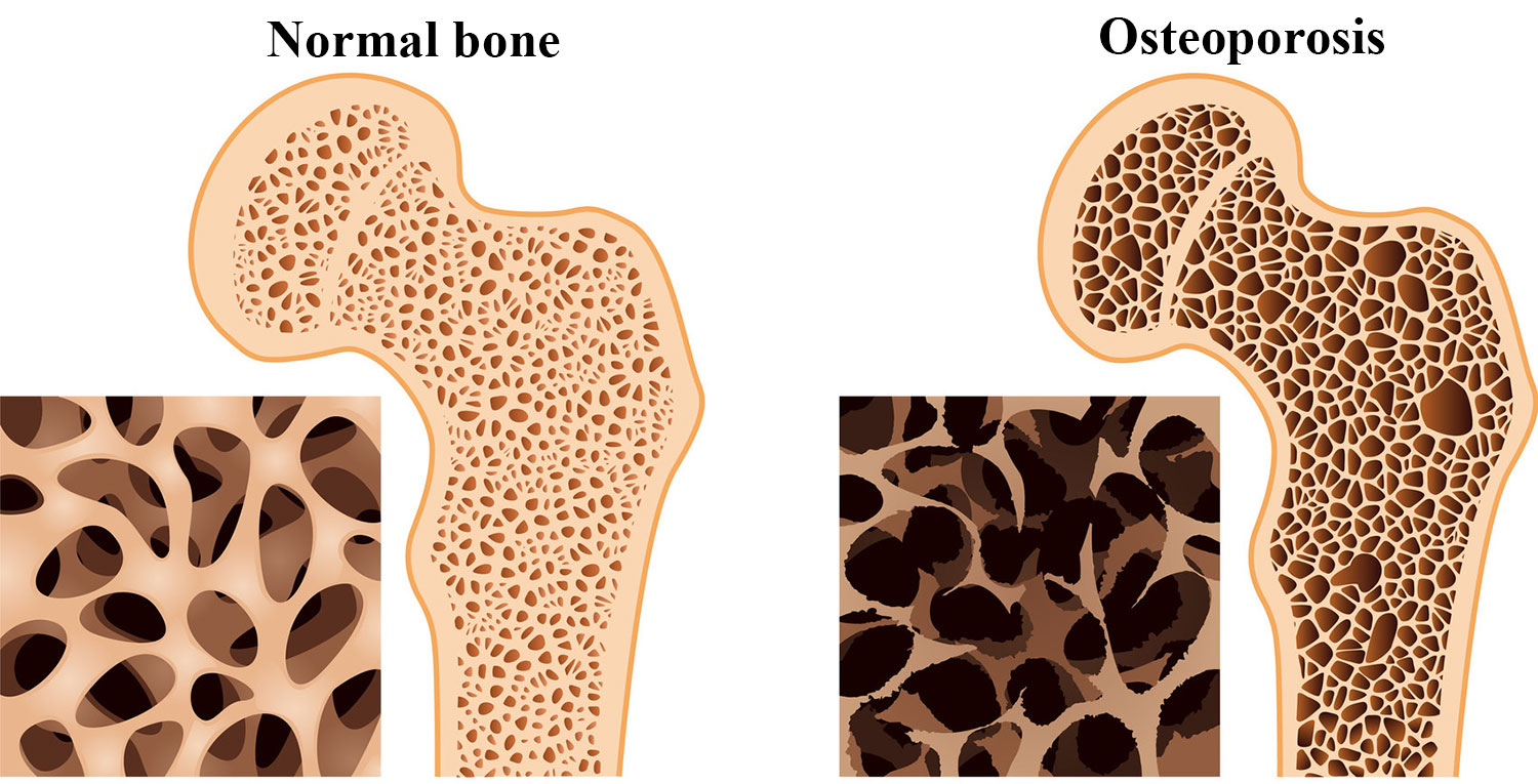 What Does Having Low Bone Density Mean