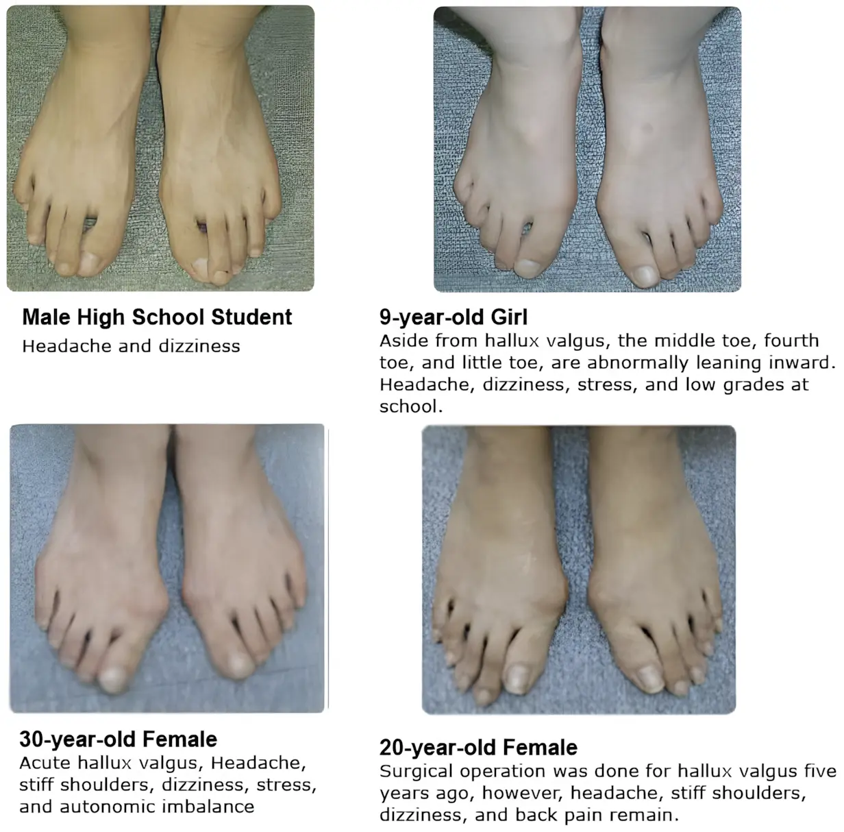 Hallux Valgus - Bunion